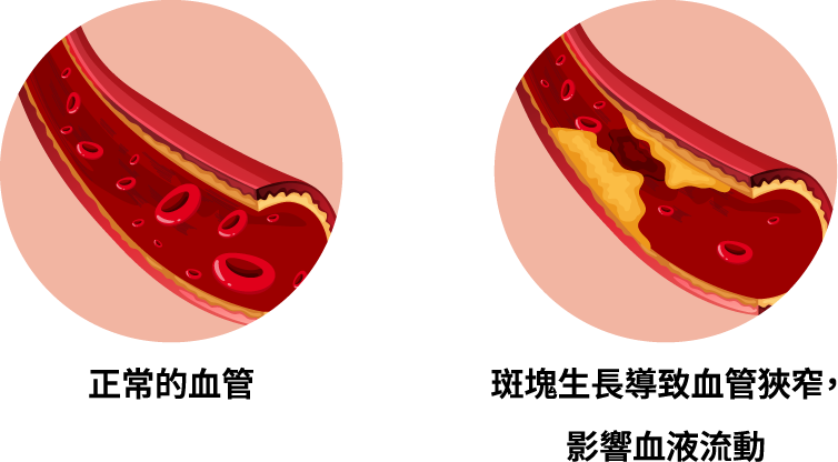 正常血管和血管鈣化的差異。左邊是內壁光滑、血液流動順暢的正常血管；右邊則因血管壁上堆積了黃色斑塊，導致管徑變窄、血流受阻，進而影響心臟健康的鈣化血管。