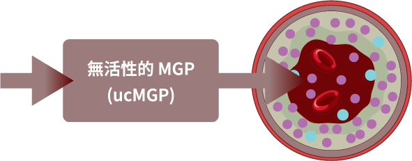 當維生素 K2 缺乏時，MGP 蛋白無法被活化，導致它無法發揮抑制鈣化的作用，使得鈣質堆積在血管壁上，造成血管鈣化。